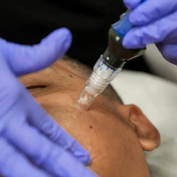 MICRONEEDLING