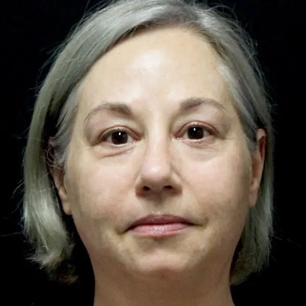 After RF Microneedling