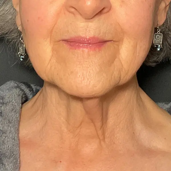 After RF Microneedling