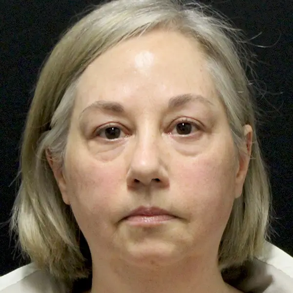 Before RF Microneedling