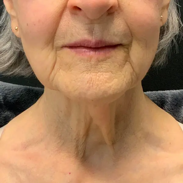 Before RF Microneedling