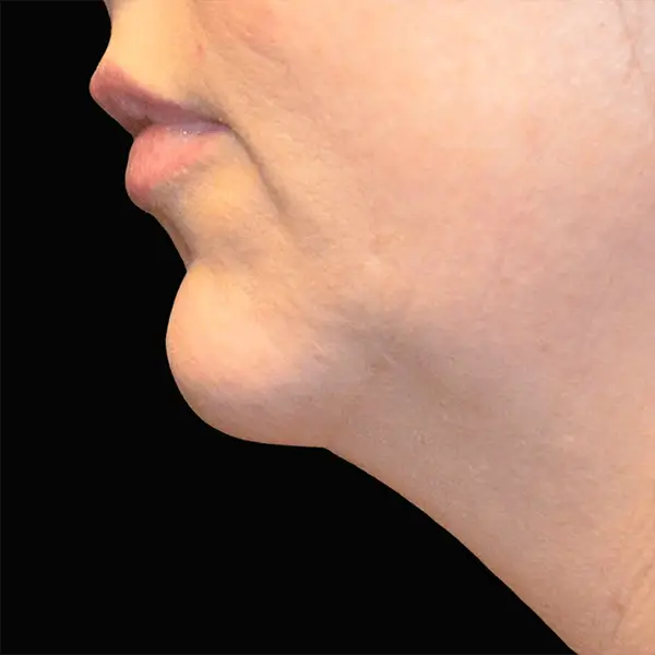 Before RF Microneedling