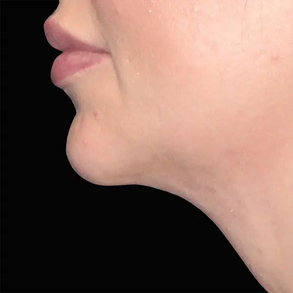 After RF Microneedling