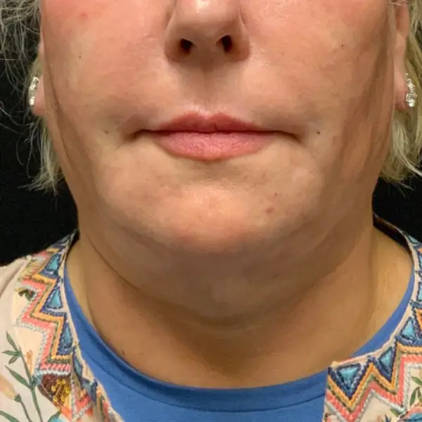 After RF Microneedling