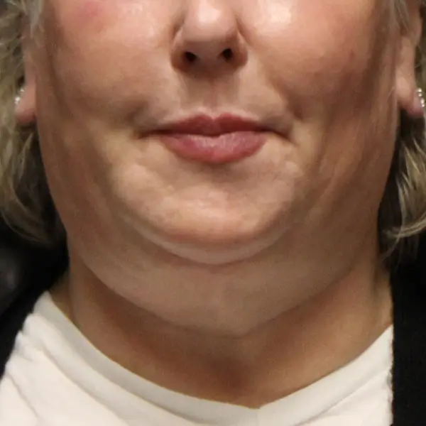 Before RF Microneedling