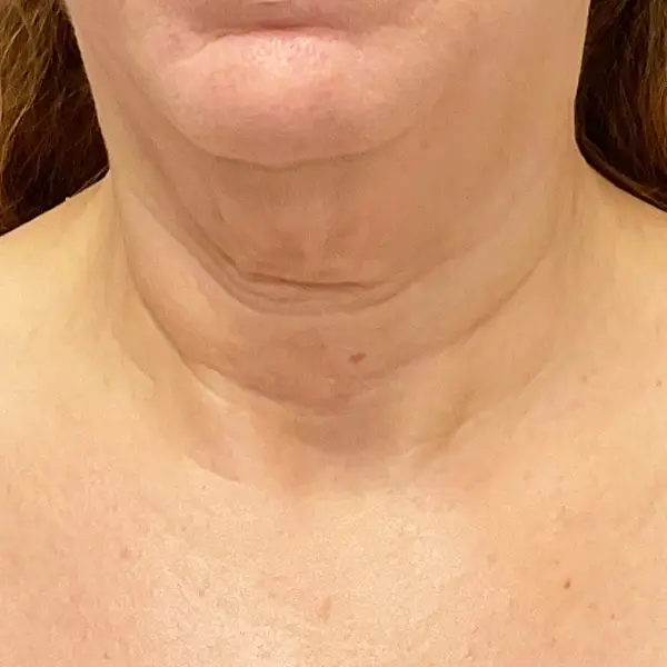 After RF Microneedling