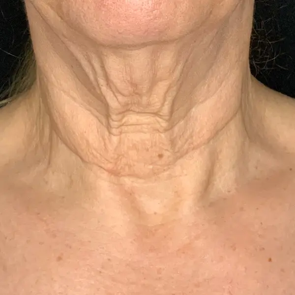 Before RF Microneedling