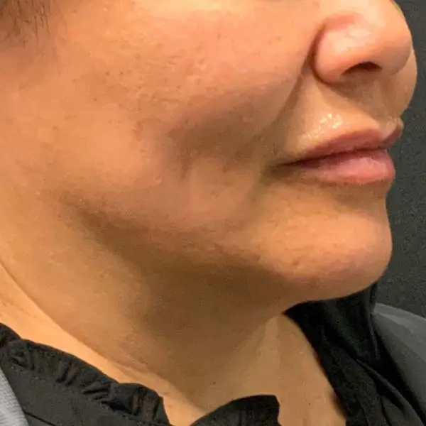 After RF Microneedling