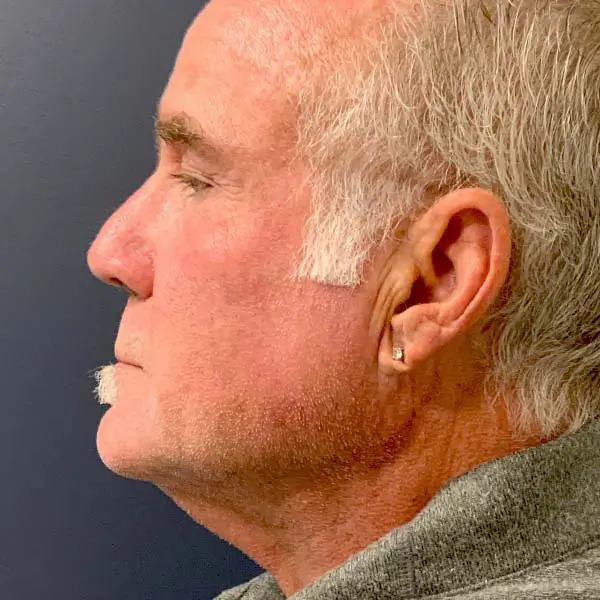 After RF Microneedling