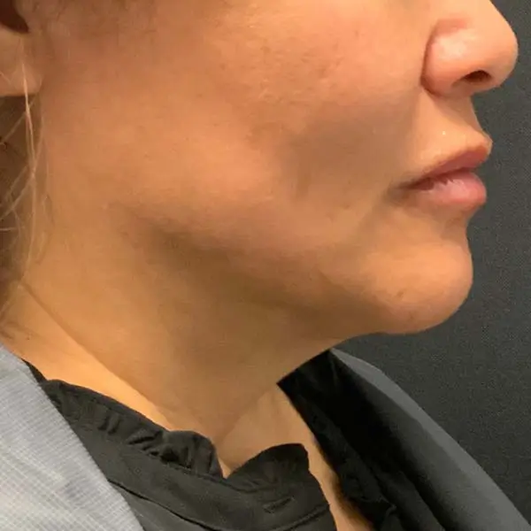After RF Microneedling