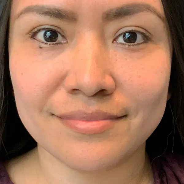 After RF Microneedling