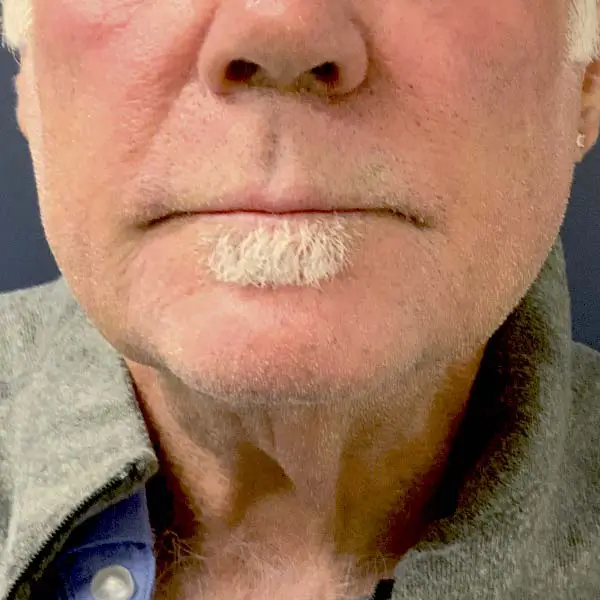 After RF Microneedling