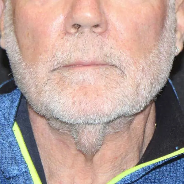 Before RF Microneedling