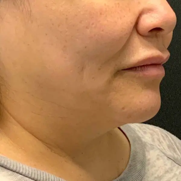 Before RF Microneedling