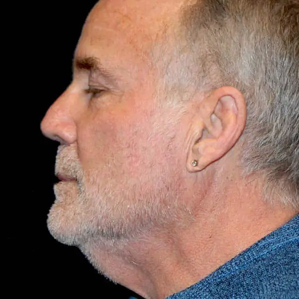 Before RF Microneedling