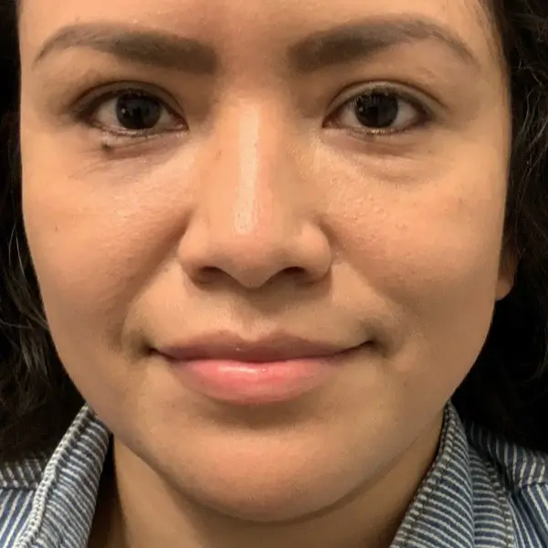 Before RF Microneedling
