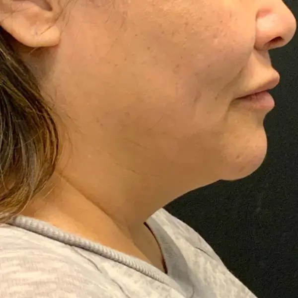 Before RF Microneedling